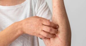 Duh, Indonesia Jadi Penyumbang Kasus Kusta Nomor 3 di Dunia Kasus Kusta di Indonesia