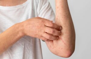 Duh, Indonesia Jadi Penyumbang Kasus Kusta Nomor 3 di Dunia Kasus Kusta di Indonesia